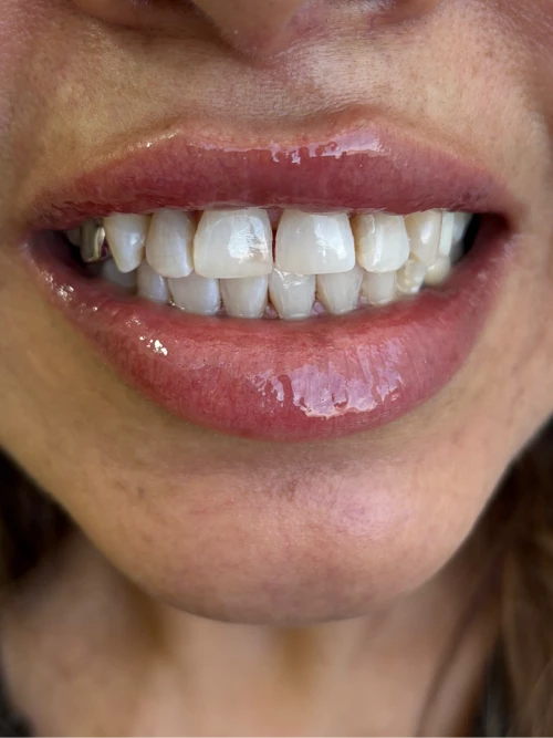 Después del tratamiento de Georgina