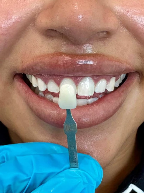 Después del tratamiento de Pao