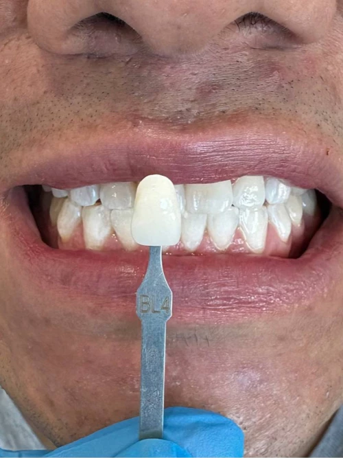 Después del tratamiento de William