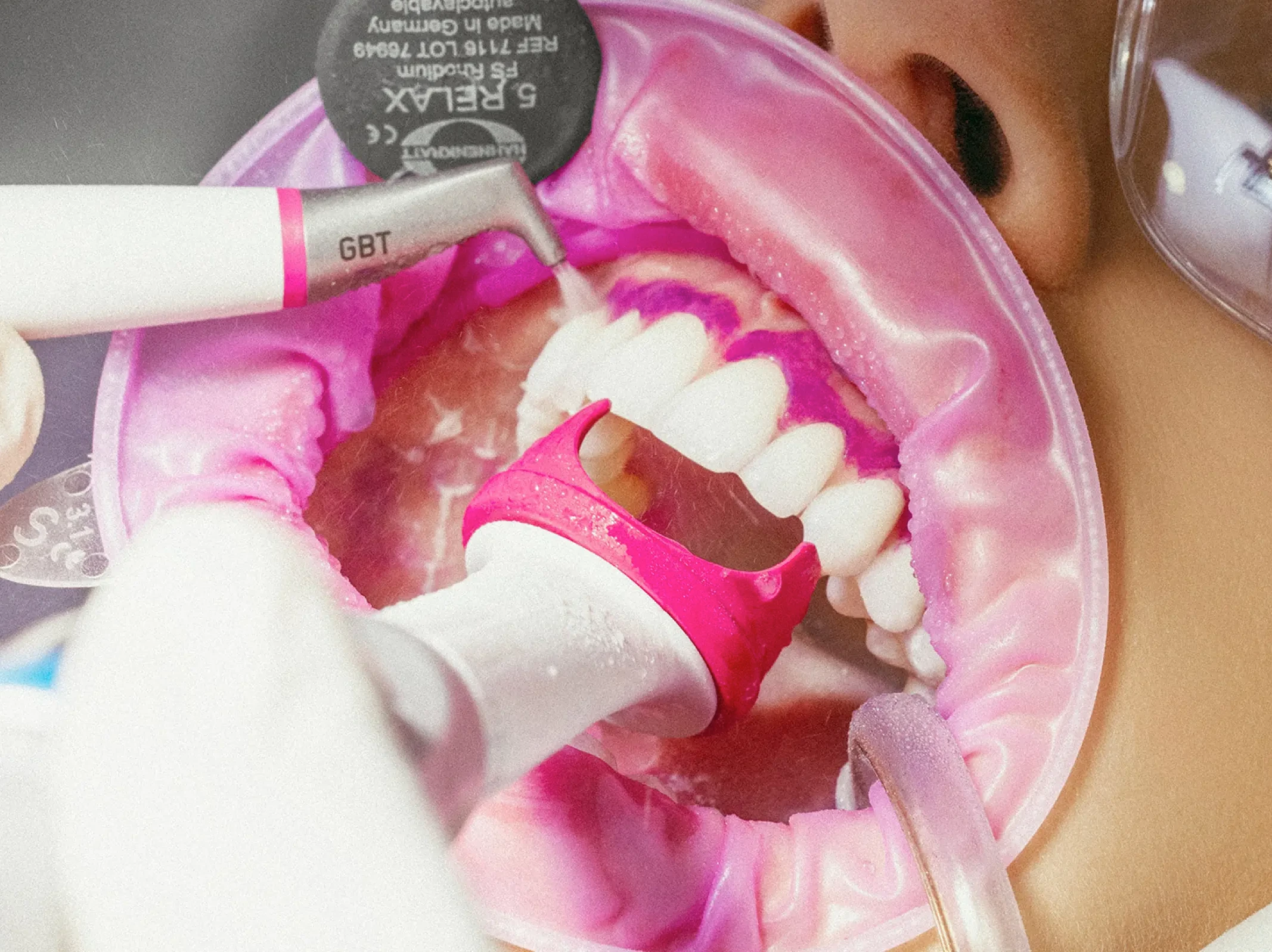 Limpieza dental